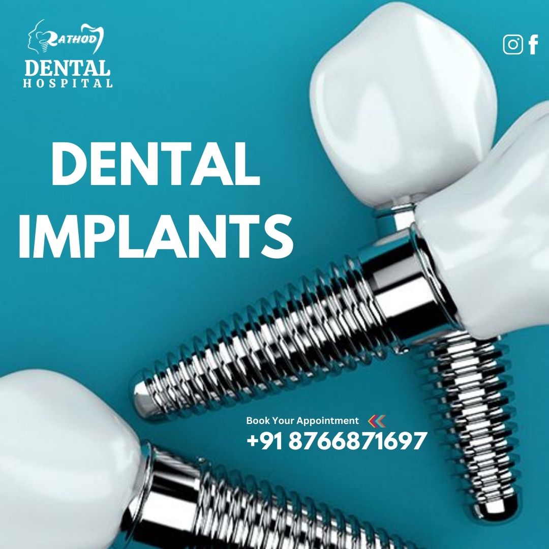 The Benefits of Dental Implants Compared to Other Tooth Replacement Options