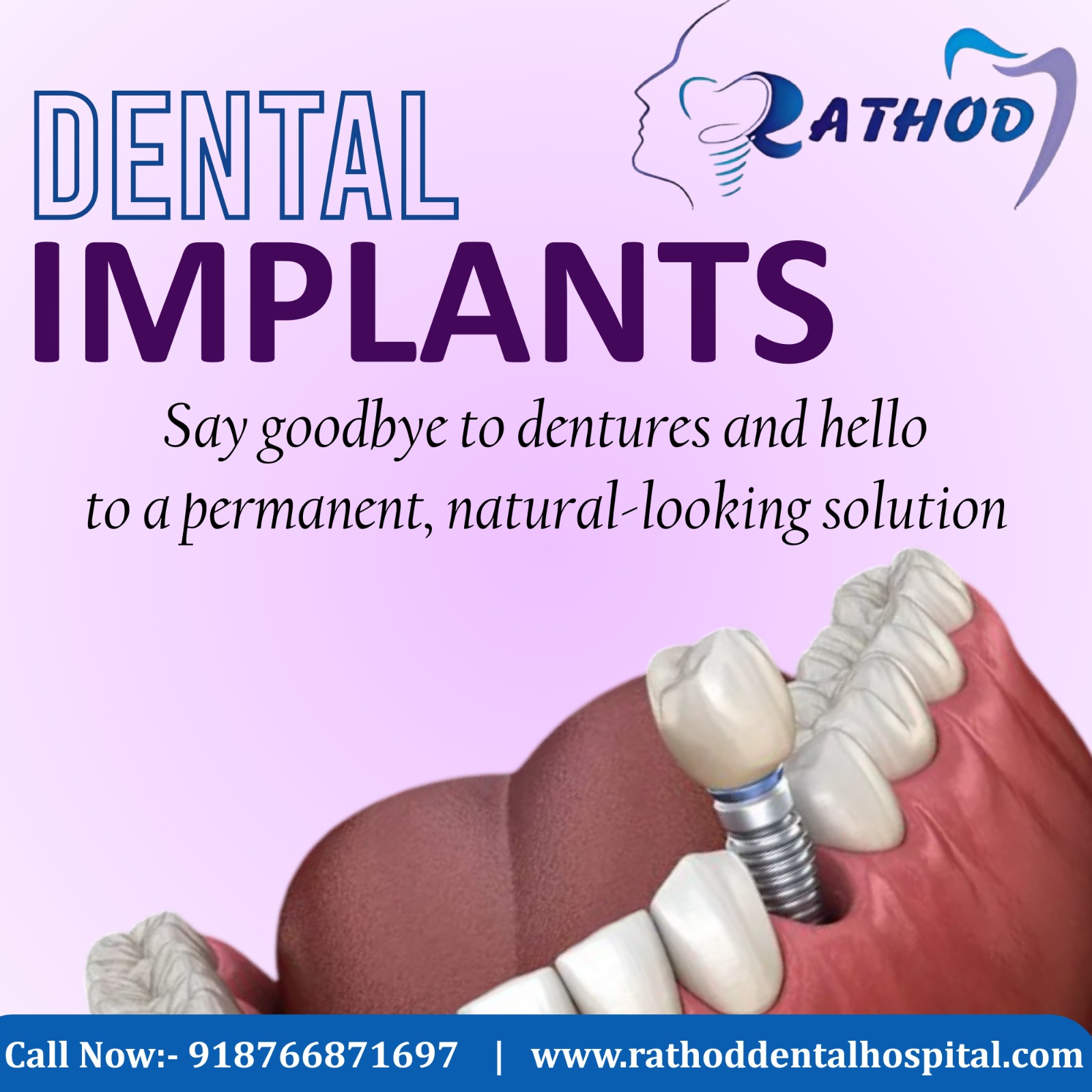 Say Goodbye to Dentures – Hello to Dental Implants!