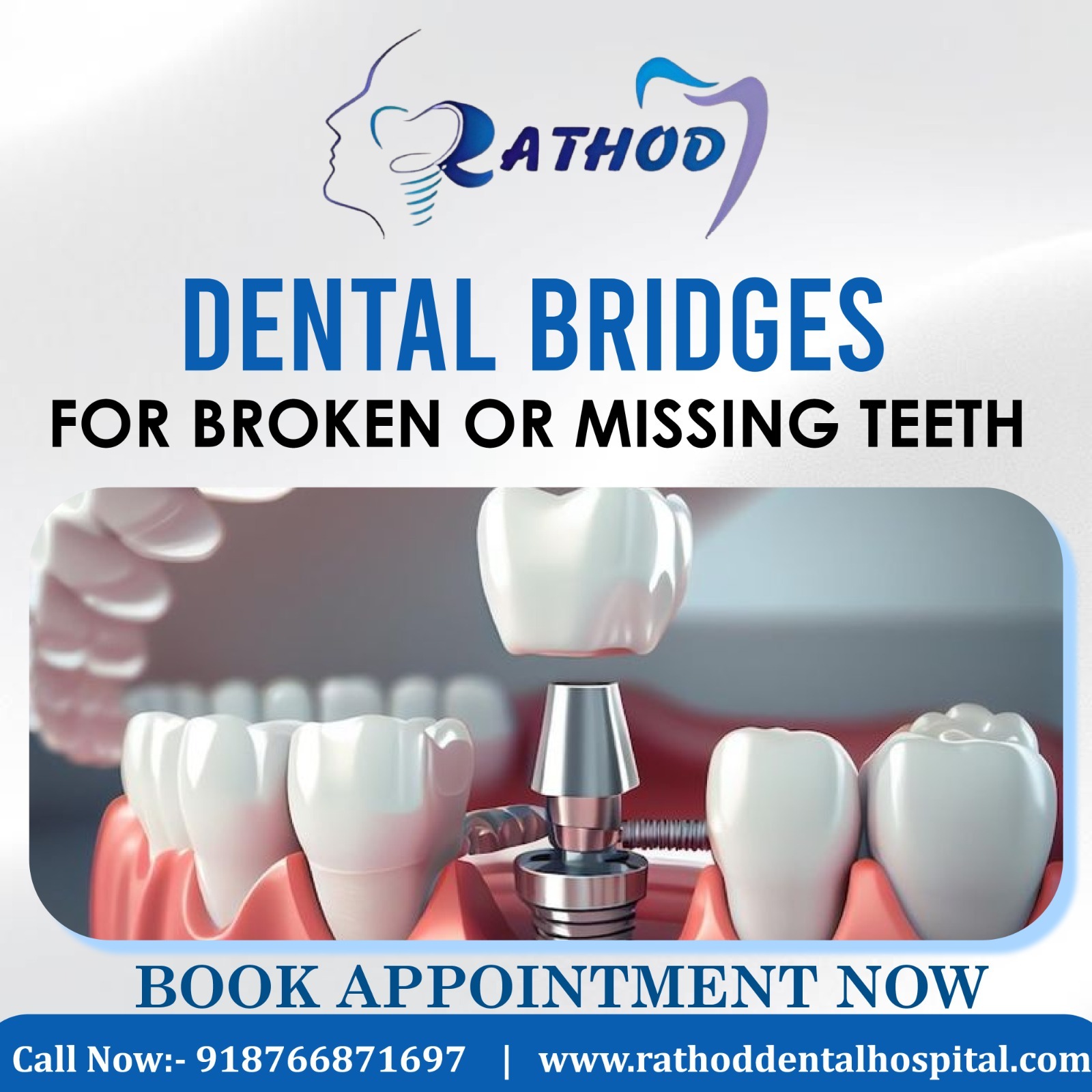 Smile Confidently Again with Dental Bridges!
