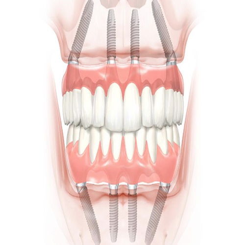 All on 4 implant