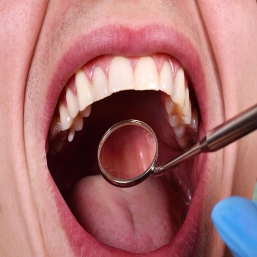 Dental Cysts & Tumors