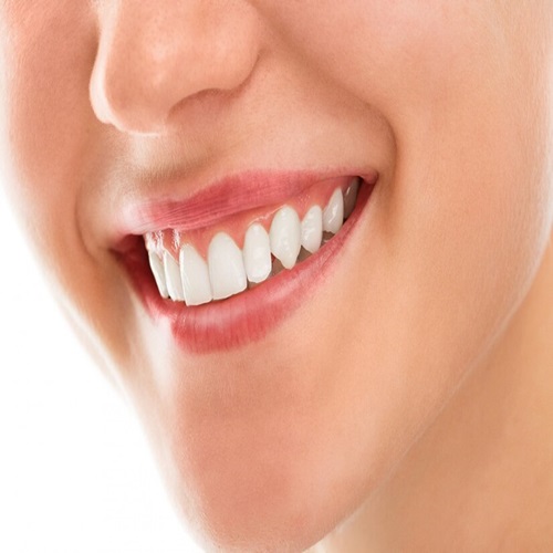 Tooth Whitening