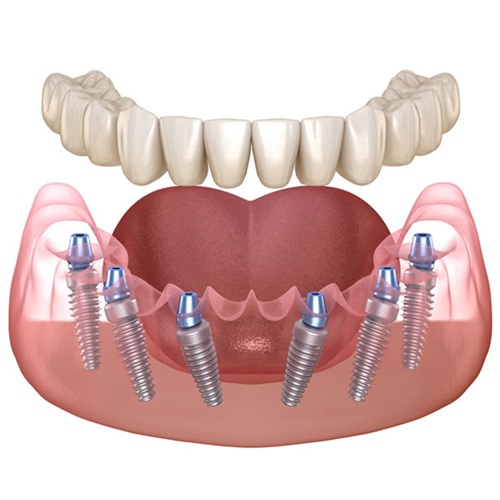 All on 6 implant